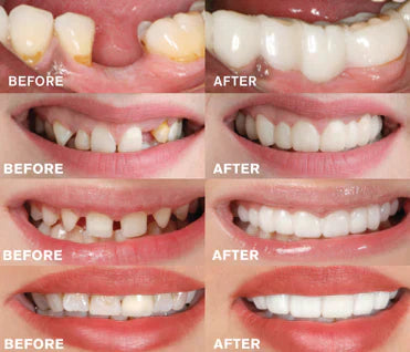 BrightDent SnapFit – Elegant and Comfortable Denture for a Radiant Smile
